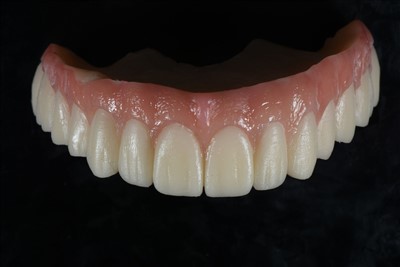 Mahkota Sementara Resin Akrilik