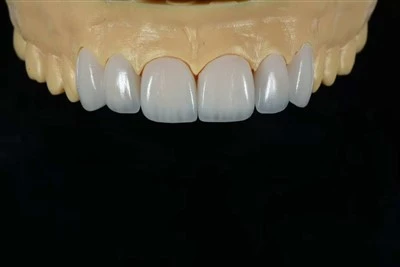 Veneer Anterior Multi-Unit