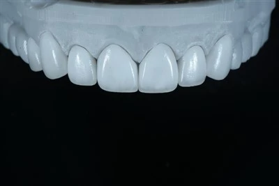 Veneer Keramik Tipis